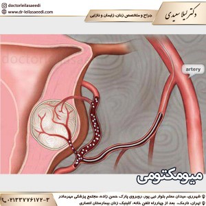 میومکتومی - دکتر سعیدی