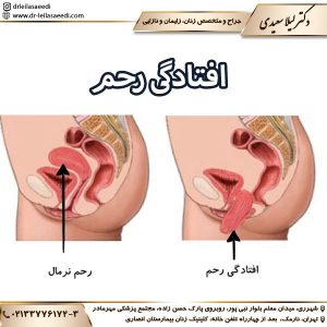 افتادگی رحم