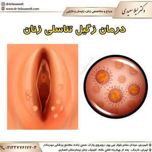 درمان زگیل تناسلی در تهران - دکتر لیلا سعیدی