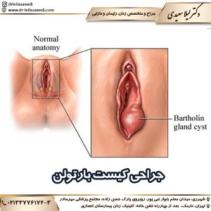 جراحی کیست بارتولن