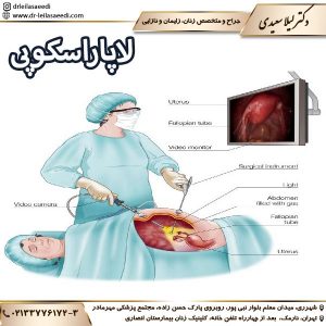 لاپاراسکوپی