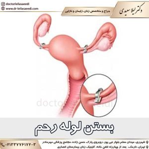بستن لوله رحم