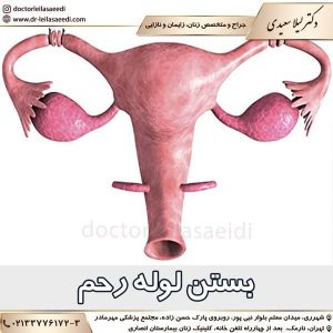 بستن لوله رحم