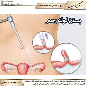 بستن لوله رحم