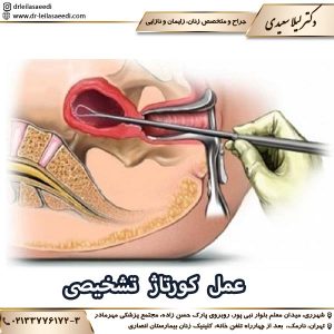 عمل کورتاژ تشخیصی