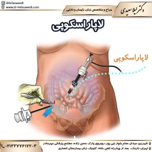 لاپاراسکوپی