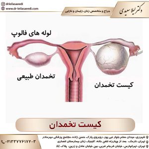 کیست تخمدان