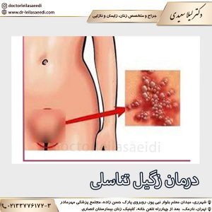 درمان زگیل تناسلی - دکتر لیلا سعیدی